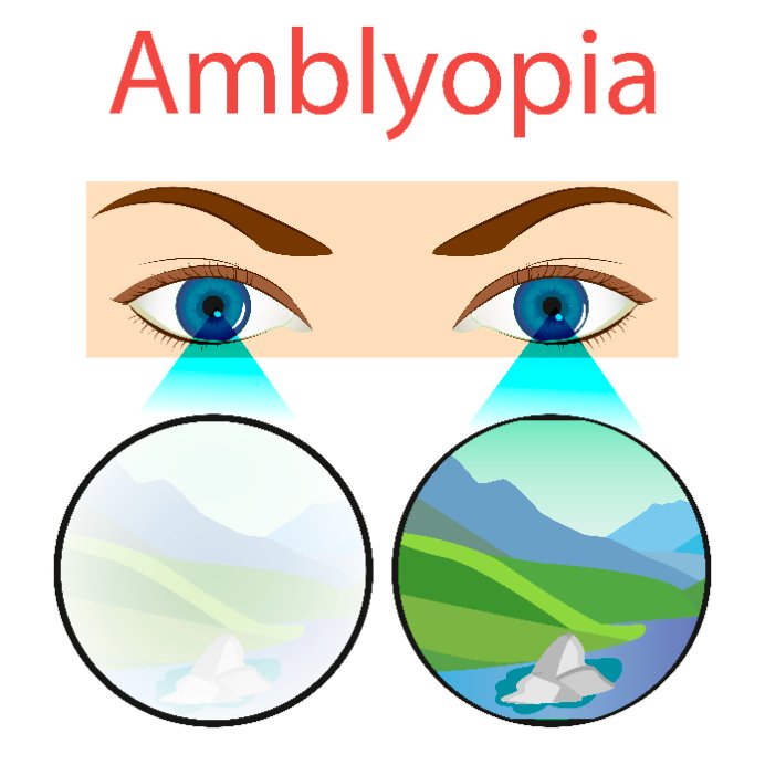 amblyopia